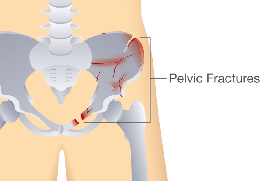 Pelvic fractures
